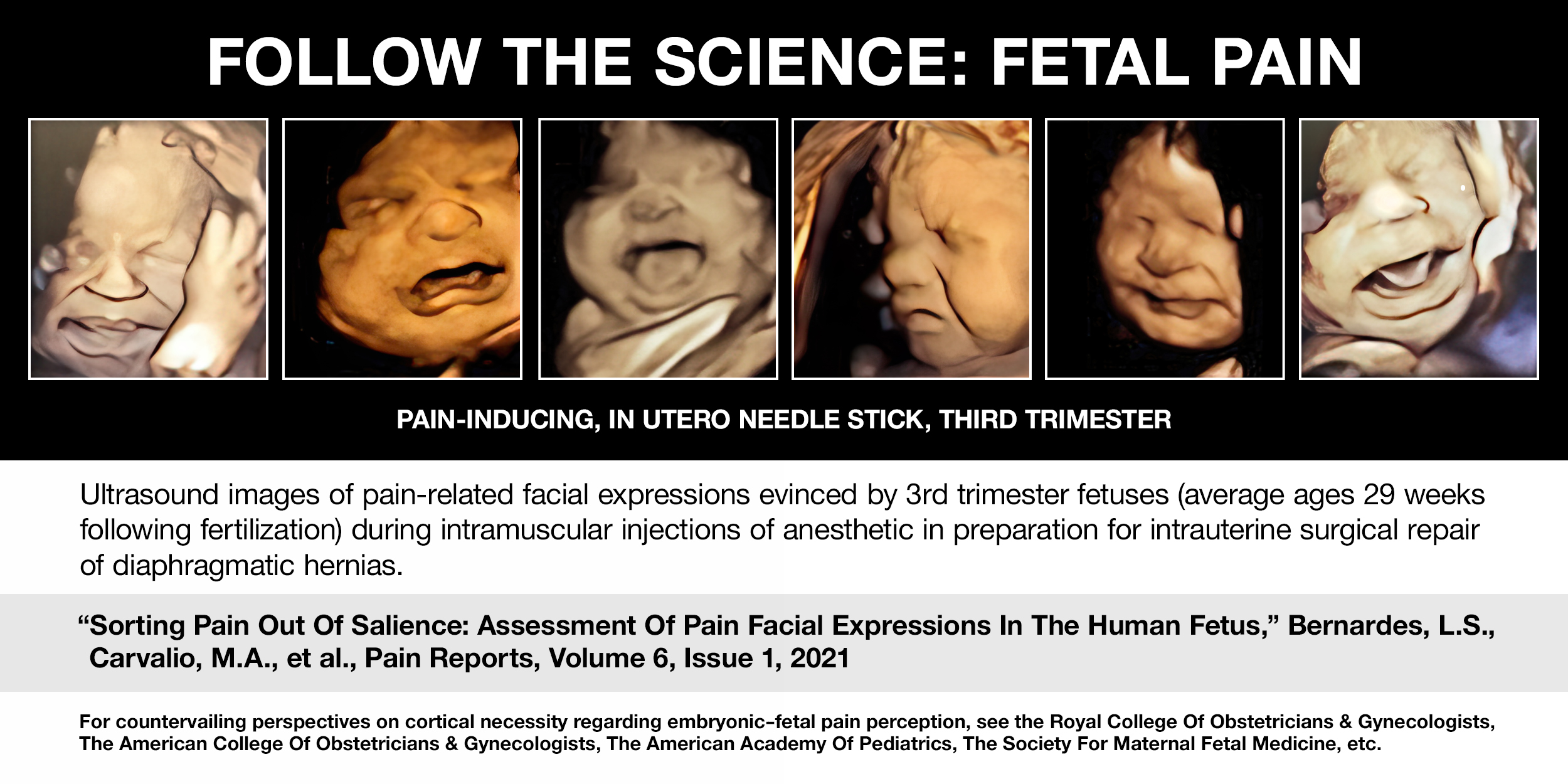 Follow the Science: Ultrasound images of pain-related facial expressions evinced by 3rd trimester fetuses