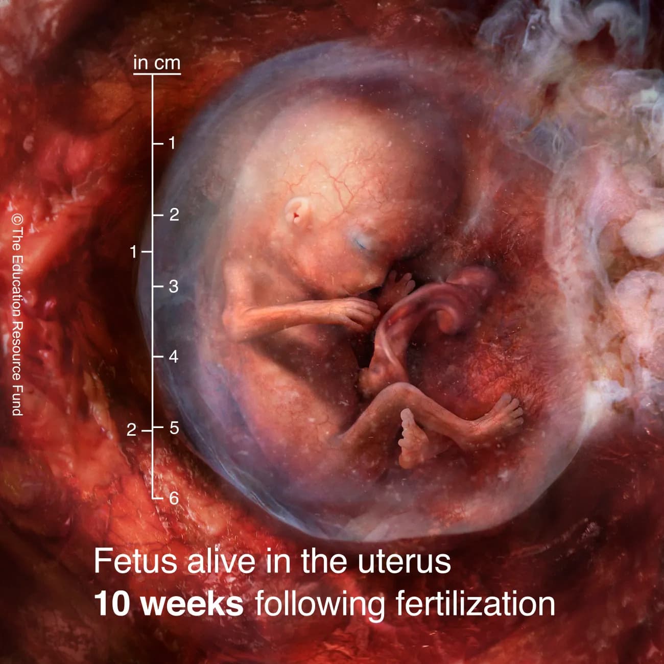 Fetus alive in the uterus 10 weeks following fertilization