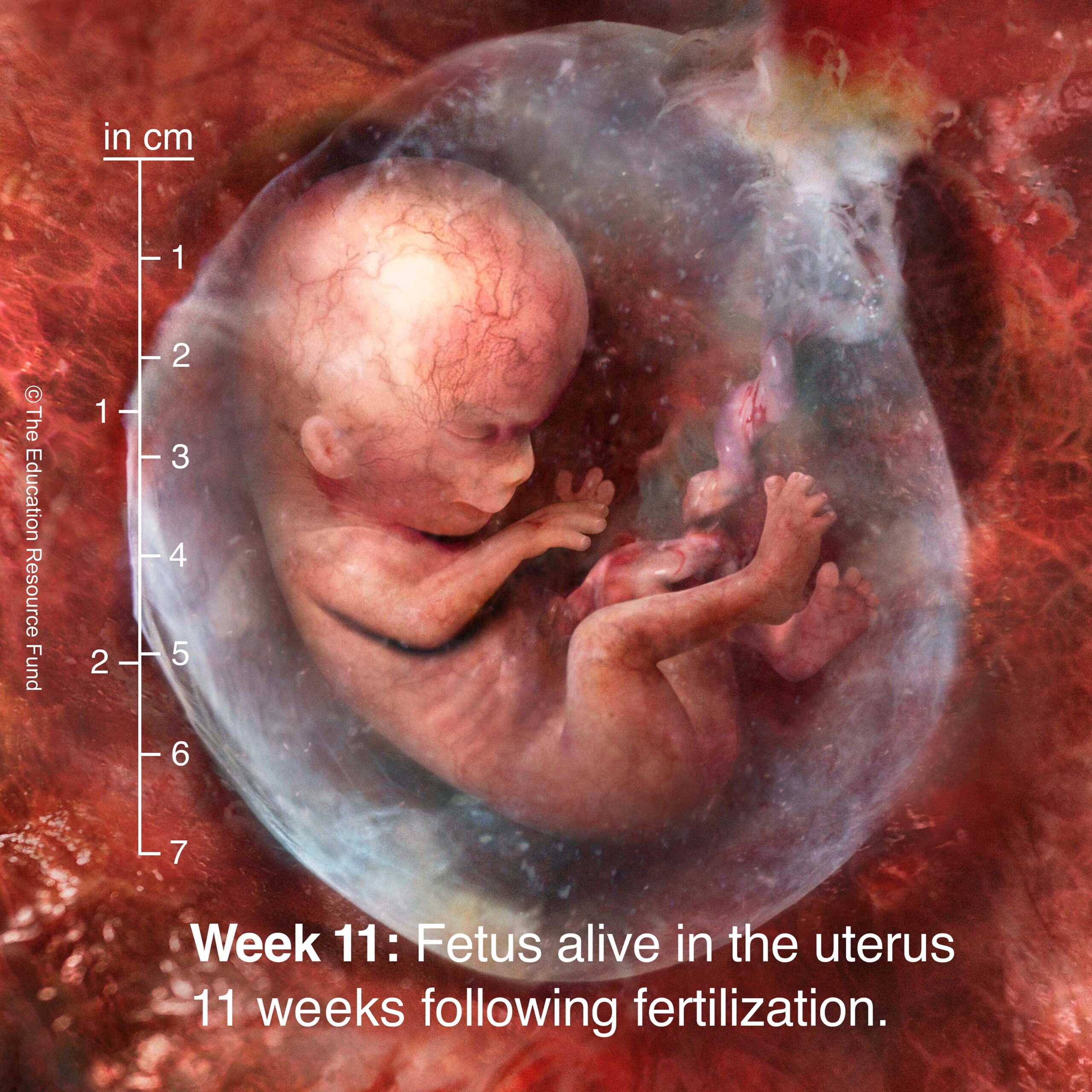 Week 11: Embryo alive in the uterus 11 weeks following fertilization
